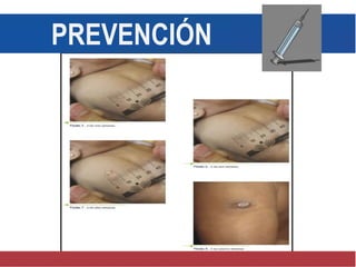 PREVENCIÓN
 