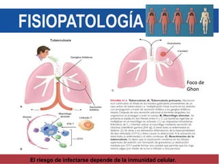 FISIOPATOLOGÍA
Foco de
Ghon
El riesgo de infectarse depende de la inmunidad celular.
 
