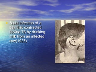 Facial infection of a boy that contracted bovine TB by drinking milk from an infected cow(1923) 