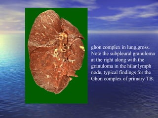 ghon complex in lung,gross.  Note the subpleural granuloma at the right along with the granuloma in the hilar lymph node, typical findings for the Ghon complex of primary TB.  