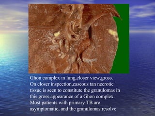 Ghon complex in lung,closer view,gross.  On closer inspection,caseous tan necrotic tissue is seen to constitute the granulomas in this gross appearance of a Ghon complex. Most patients with primary TB are asymptomatic, and the granulomas resolve 