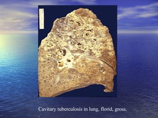 Cavitary tuberculosis in lung, florid, gross.  .  