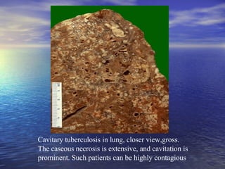Cavitary tuberculosis in lung, closer view,gross.  The caseous necrosis is extensive, and cavitation is prominent. Such patients can be highly contagious 