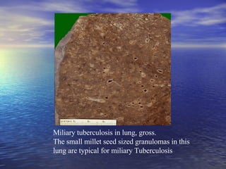 Miliary tuberculosis in lung, gross.  The small millet seed sized granulomas in this lung are typical for miliary Tuberculosis 