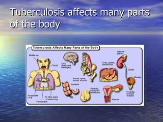 Tuberculosis affects many parts of the body 