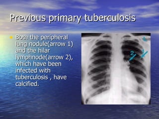 Previous primary tuberculosis Both the peripheral lung nodule(arrow 1) and the hilar lymphnode(arrow 2), which have been infected with tuberculosis , have calcified. 
