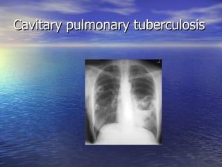 Cavitary pulmonary tuberculosis 
