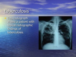 tuberculosis This radiograph shows a patient with typical radiographic findings of tuberculosis. 