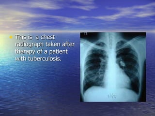 This is  a chest radiograph taken after therapy of a patient with tuberculosis. 