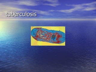 tuberculosis 