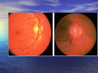 irregular respiration develops 