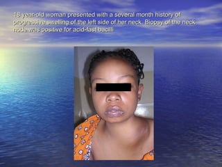 18 year-old woman presented with a several month history of  progressive swelling of the left side of her neck. Biopsy of the neck  node was positive for acid-fast bacilli 