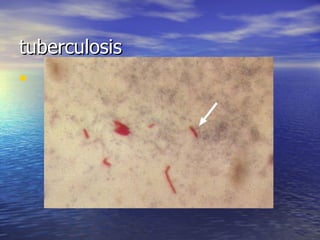 tuberculosis 