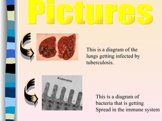 h


    This is a diagram of the
    lungs getting infected by
    tuberculosis.




        This is a diagram of
        bacteria that is getting
        Spread in the immune system
 
