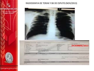 RADIOGRAFIA DE TORAX Y BK DE ESPUTO (NOV/2013)
DICIEMBRE/2013
 