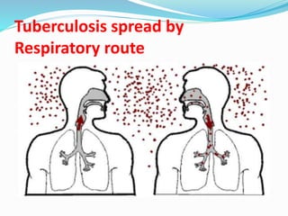 Tuberculosis spread by
Respiratory route
 