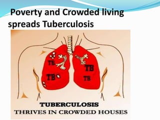 Poverty and Crowded living
spreads Tuberculosis
 