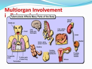 Multiorgan Involvement
in Tuberculosis.
 