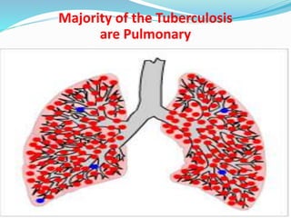 Dr.T.V.Rao MD 30
Majority of the Tuberculosis
are Pulmonary
 