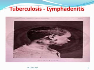 Dr.T.V.Rao MD 34
Tuberculosis - Lymphadenitis
 