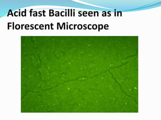 Acid fast Bacilli seen as in
Florescent Microscope
 