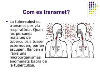 Tuberculosi