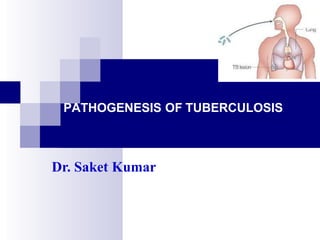 PATHOGENESIS OF TUBERCULOSIS
Dr. Saket Kumar
 
