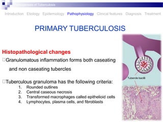 tuberculosis .pptx