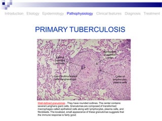 Caseated tuberculosis .pptx