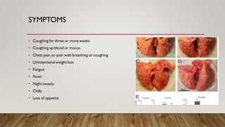 SYMPTOMS
• Coughing for three or more weeks
• Coughing up blood or mucus
• Chest pain,or pain with breathing or coughing
• Unintentional weight loss
• Fatigue
• Fever
• Night sweats
• Chills
• Loss of appetite
 