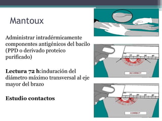 Mantoux
Administrar intradérmicamente
componentes antigénicos del bacilo
(PPD o derivado proteico
purificado)
Lectura 72 h:induración del
diámetro máximo transversal al eje
mayor del brazo
Estudio contactos
 