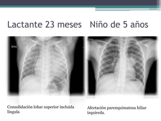 Lactante 23 meses Niño de 5 años
Afectación parenquimatosa hiliar
izquierda.
Consolidación lobar superior incluida
língula
 