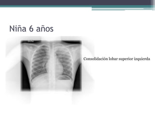 Niña 6 años
Consolidación lobar superior izquierda
 