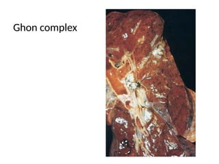 Ghon complex
 