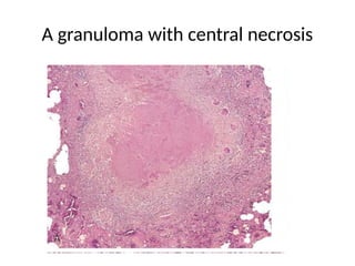A granuloma with central necrosis
 