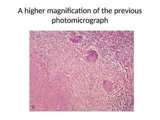 A higher magnification of the previous
photomicrograph
 