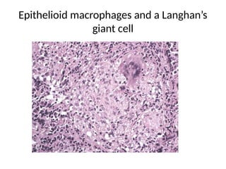 Epithelioid macrophages and a Langhan’s
giant cell
 