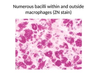 Numerous bacilli within and outside
macrophages (ZN stain)
 