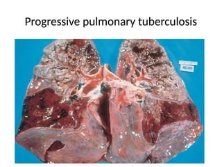 Progressive pulmonary tuberculosis
 