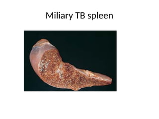 Miliary TB spleen
 