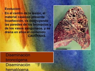 Evolución: 
• En el centro de la lesión, el 
material caseoso presenta 
licuefacción, va destruyendo 
las paredes de los bronquios y 
de los vasos sanguíneos, y se 
drena en ellos el contenido 
CAVERNAS. 
Diseminación 
broncógena. 
Diseminación 
hematógena. 
 