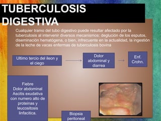 TUBERCULOSIS 
DIGESTIVA 
• Cualquier tramo del tubo digestivo puede resultar afectado por la 
tuberculosis al intervenir diversos mecanismos: deglución de los esputos, 
diseminación hematógena, o bien, infrecuente en la actualidad, la ingestión 
de la leche de vacas enfermas de tuberculosis bovina 
Ultimo tercio del ileon y 
el ciego 
Dolor 
abdominal y 
diarrea 
Fiebre 
Dolor abdominal 
Ascitis exudativa 
con numero alto de 
proteinas y 
leucositosis 
linfacitica. Biopsia 
peritoneal 
Enf. 
Crohn. 
 