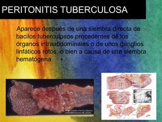 PERITONITIS TUBERCULOSA 
Aparece después de una siembra directa de 
bacilos tuberculosos procedentes de los 
órganos intraabdominales o de unos ganglios 
linfáticos rotos, o bien a causa de una siembra 
hematógena 
 