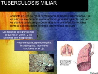 TUBERCULOSIS MILIAR 
• Consiste en una siembra hematógena de bacilos tuberculosos. En 
los niños suele deberse a una infección primaria reciente, pero en 
los adultos puede ser secundaria tanto a una infección reciente 
como a la reactivación de focos diseminados antiguos 
Las lesiones son granulomas 
pequeños (1-2 mm) y los 
sintomas son inespecificos. 
Hepatomegalia,esplenomegalia, 
linfadenopatia, tuberculos 
coroideos en el ojo. 
 