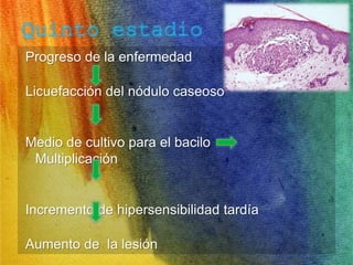 Progreso de la enfermedad 
Licuefacción del nódulo caseoso 
Medio de cultivo para el bacilo 
Multiplicación 
Incremento de hipersensibilidad tardía 
Aumento de la lesión 
 