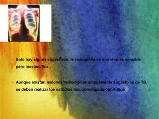 RADIOLOGIA 
• Solo hay signos sugestivos, la radiografía es una técnica sensible 
pero inespecífica 
• Aunque existan lesiones radiológicas ampliamente sugestivas de TB, 
se deben realizar los estudios microbiológicos oportunos 
 
