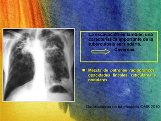 • La excavación es también una 
característica importante de la 
tuberculosis secundaria. 
Cavernas 
 Mezcla de patrones radiográficos: 
opacidades lineales, reticulares y 
nodulares. 
Guías clínicas de tuberculosis OMS 2010 
 