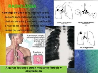 RADIOLOGIA 
Complejo de Ghon es la presencia de una 
pequeña zona radiopaca por debajo de la 
clavícula derecha, junto a una calcificación 
a nivel de los ganglios linfáticos hilares, 
unidos por un trazo lineal. 
Algunas lesiones curan mediante fibrosis y 
calcificación 
 