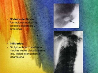 • Nódulos de Simón; 
formaciones nodulares 
apicales bilaterales y 
simétricas 
• Infiltrados: 
• De tipo nuboso o moteado, 
muchas veces ubicadas en el 
íleo, lesión intensamente 
inflamatoria 
 