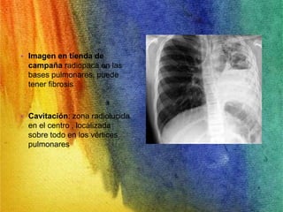 • Imagen en tienda de 
campaña radiopaca en las 
bases pulmonares, puede 
tener fibrosis 
• Cavitación: zona radiolucida 
en el centro , localizada 
sobre todo en los vértices 
pulmonares 
 